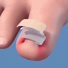 ¡Despídete de los hongos en tus uñas!